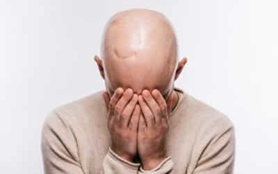 Alopecia Androgénica