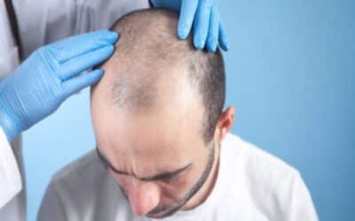 Clínica trasplante capilar: Soluciones efectivas para la restauración del cabello